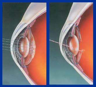 laser eye surgery 5 years later
 on ophthalmologist eye doctor nd yag laser laser doktor mata ...