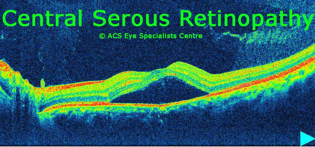 Central Serous Retinopathy