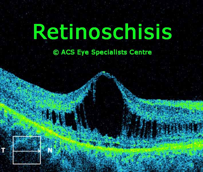 OCT Retinoschisis